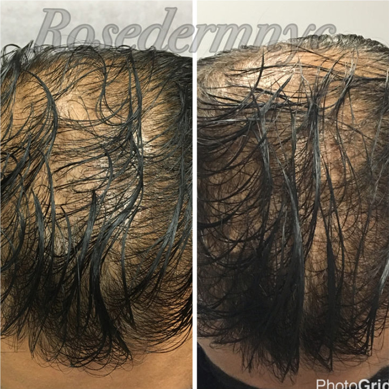 Hair Restoration Astoria