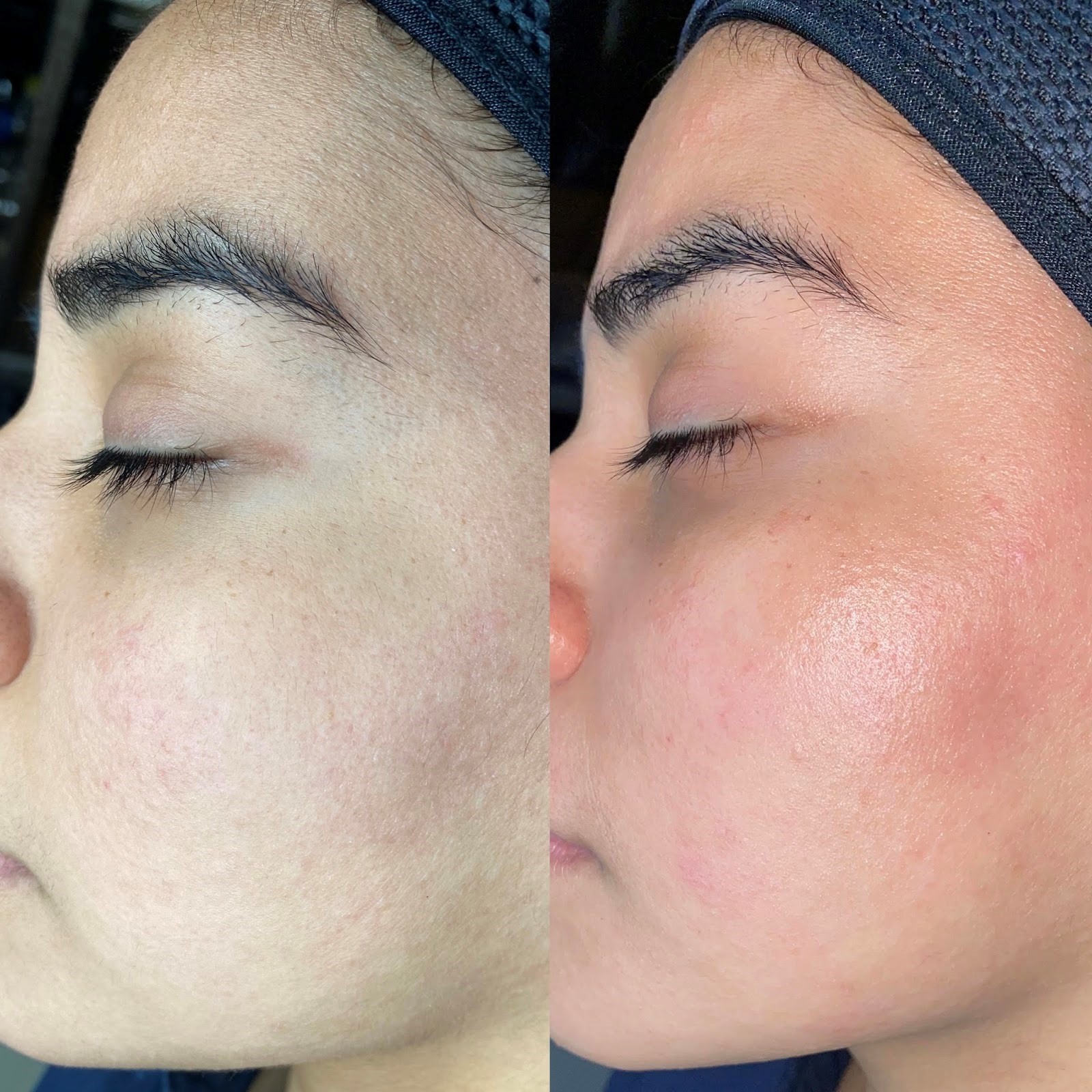 client results for dermaplanning