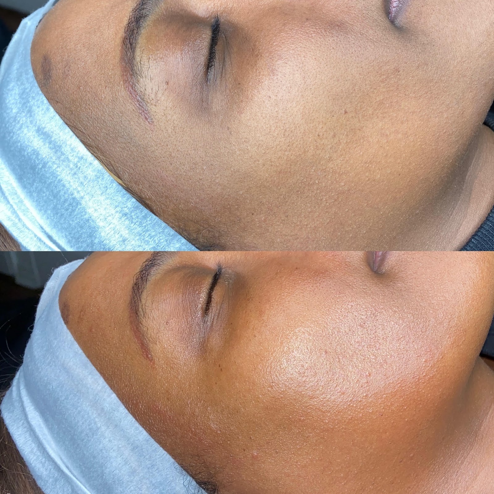 client results for dermaplaning